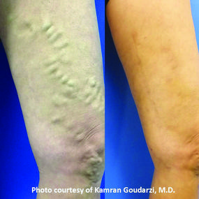 Chronic Venous Insufficiency Specialist - Dallas, TX & Hurst, TX: Texas  Vascular Institute: Varicose Vein Specialist