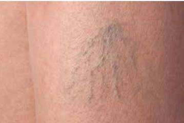 Sclerotherapy Treatment of Spider Veins